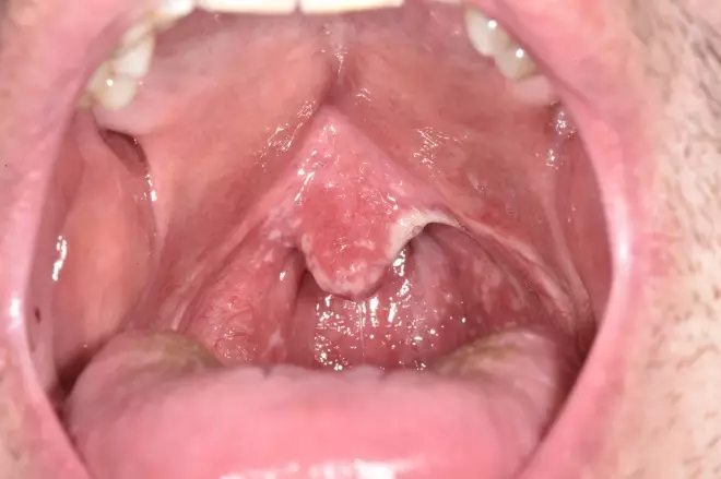 Kandidozinė grybelinė infekcija burnos gleivinė