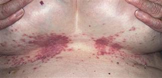 Kandidozinė grybelinė infekcija odos liga krutinė