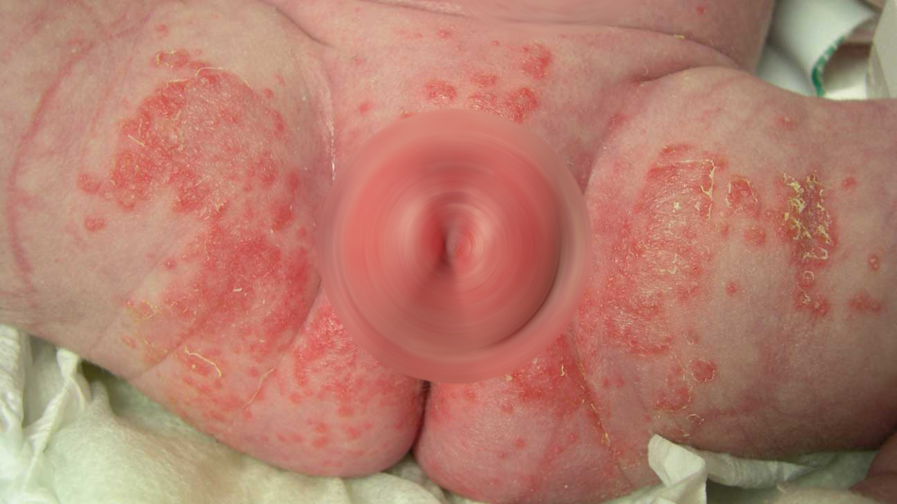 Kandidozinė grybelinė infekcija vaikui ant kūno