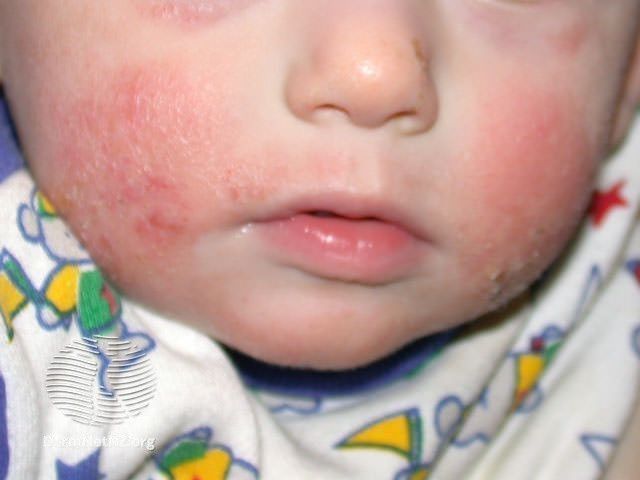 Атопический дерматит у маленького ребенка