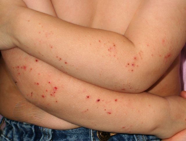 Атопический дерматит у ребенка