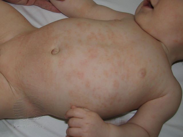 Atopinis-dermatitas-Vaikas