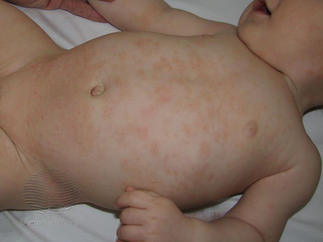 Atopic-dermatitis-Child