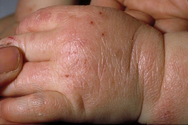 Atopinis dermatitas mažam vaikui