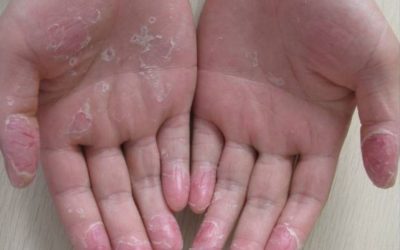 Viena iš galimų odos lupimosi priežasčių – eksfoliacinė keratolizė