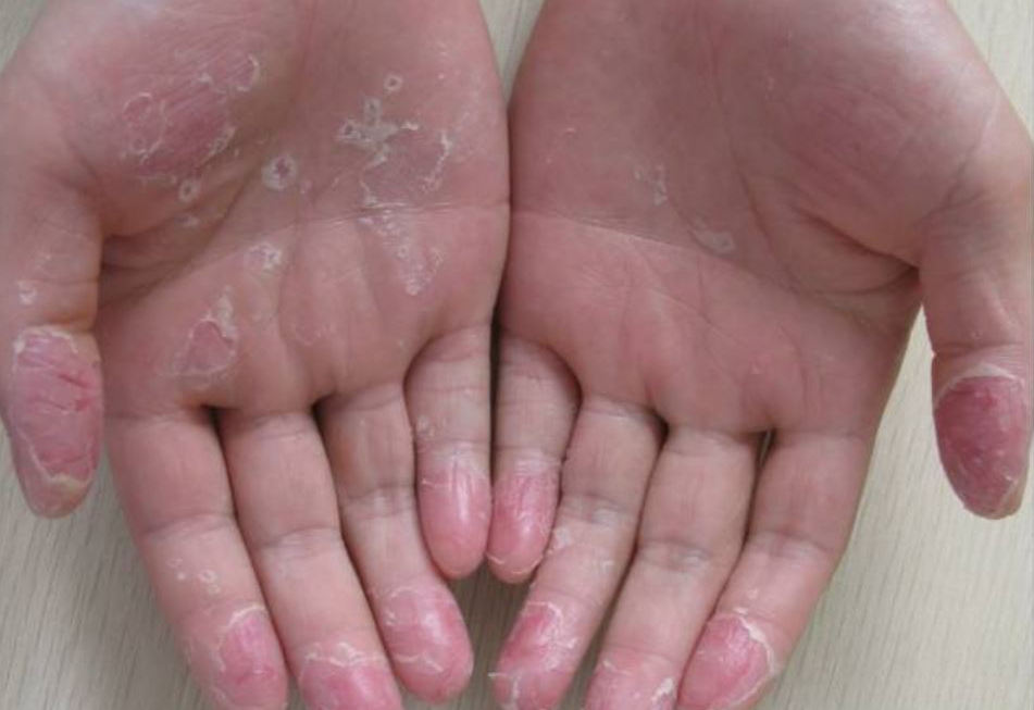 Eksfoliacinės keratolizė rankos