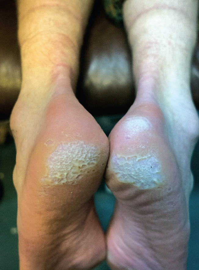 Pitted Keratolysis soles