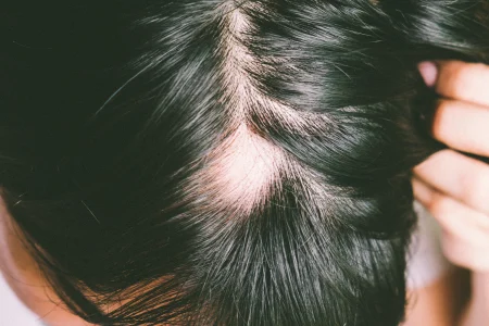 Židininė alopecija Odos ligos