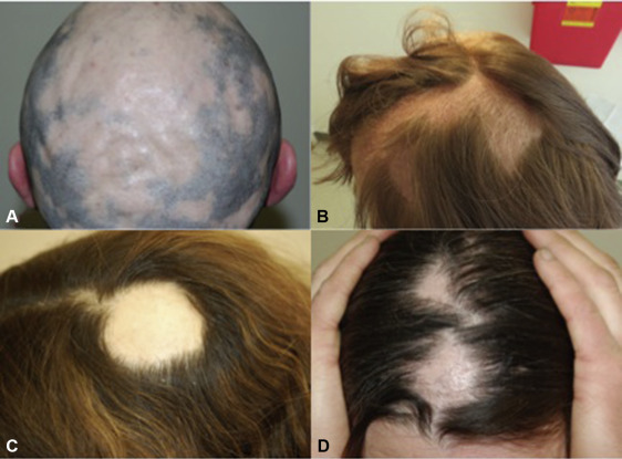 Židininė alopecija (alopecia areata) 2