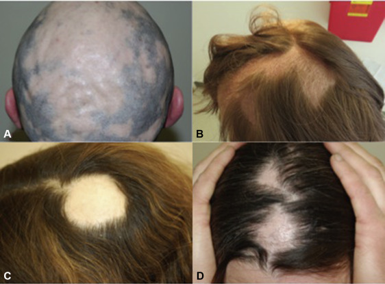 Focal alopecia (alopecia areata) 2