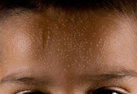 Blizgančioji kerpligė odos liga ant veido