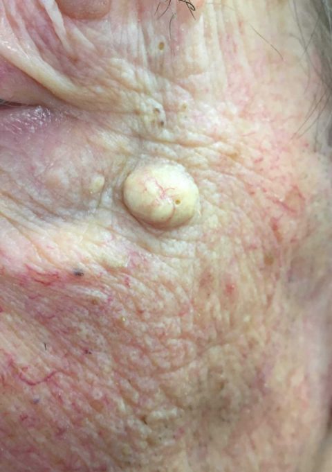 Epidermoidinė cista - Dermatologo konsultacija internetu