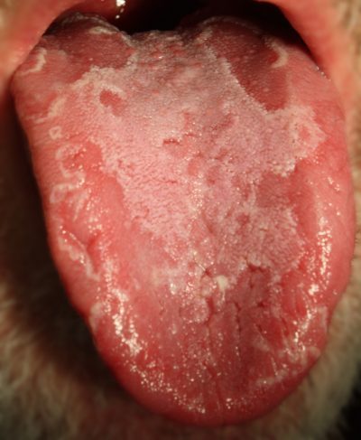 Geographic tongue 2