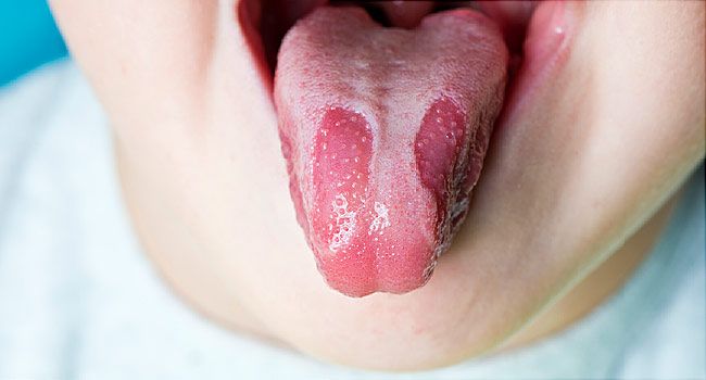 Geographic tongue child 2