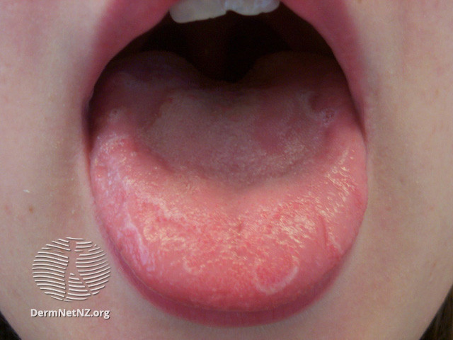 Geographic tongue child