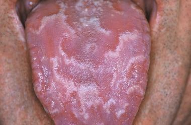 Geographic tongue