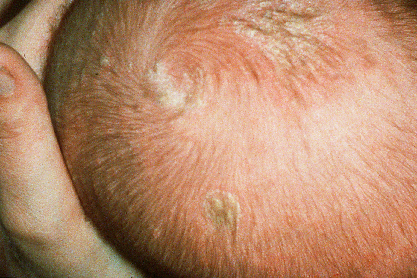 Cradle cap