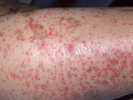 Petechiae - Vasculitis