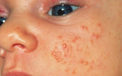 Skin conditions in newborns