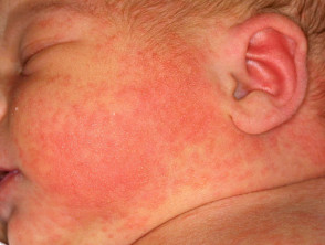 Erythema toxicum neonatorum