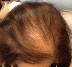 Androgenic hair loss 3