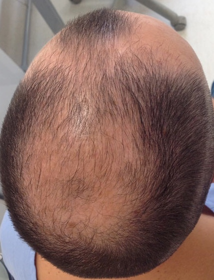 Androgenic hair loss