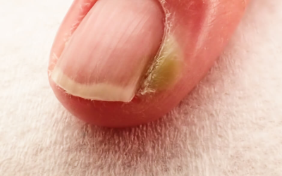 The most common nail changes