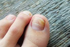 Onychomycosis