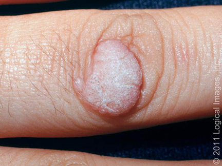 Common viral wart