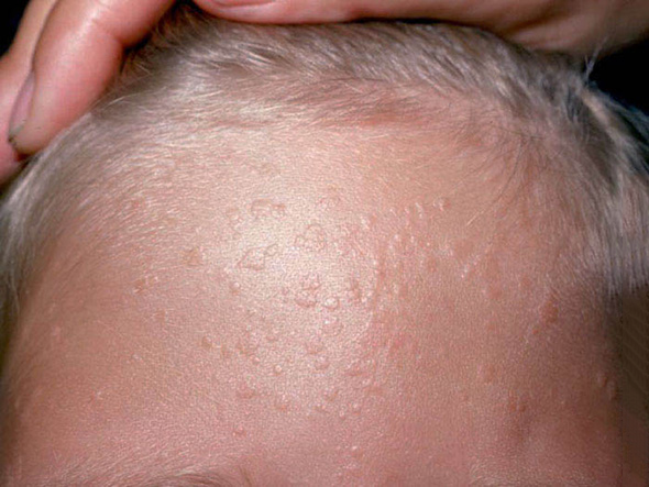 Viral wart forehead