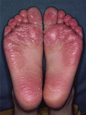 Juvenile plantar dermatosis of the legs