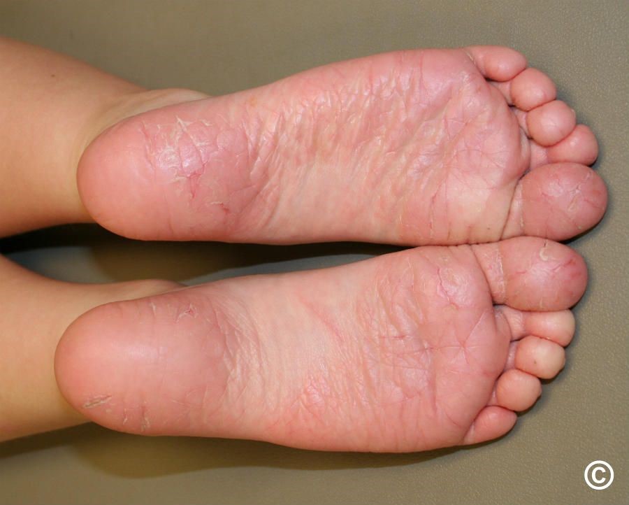 Juvenilinė plantarinė dermatozė vaiko kojos 2