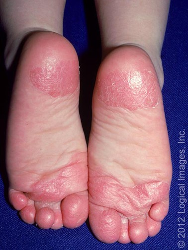 Juvenile plantar dermatosis of a child's feet