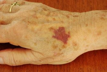 Paprastoji purpura ant rankos - odos liga