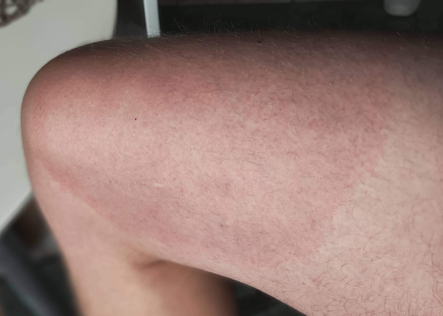 Lyme disease - on the leg