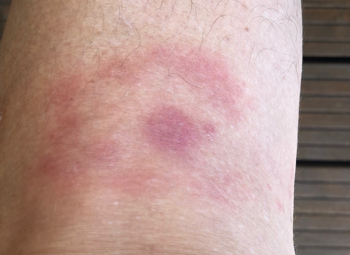 Lyme disease - leg 3