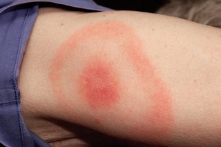 Lyme disease - borreliosis - skin diseases