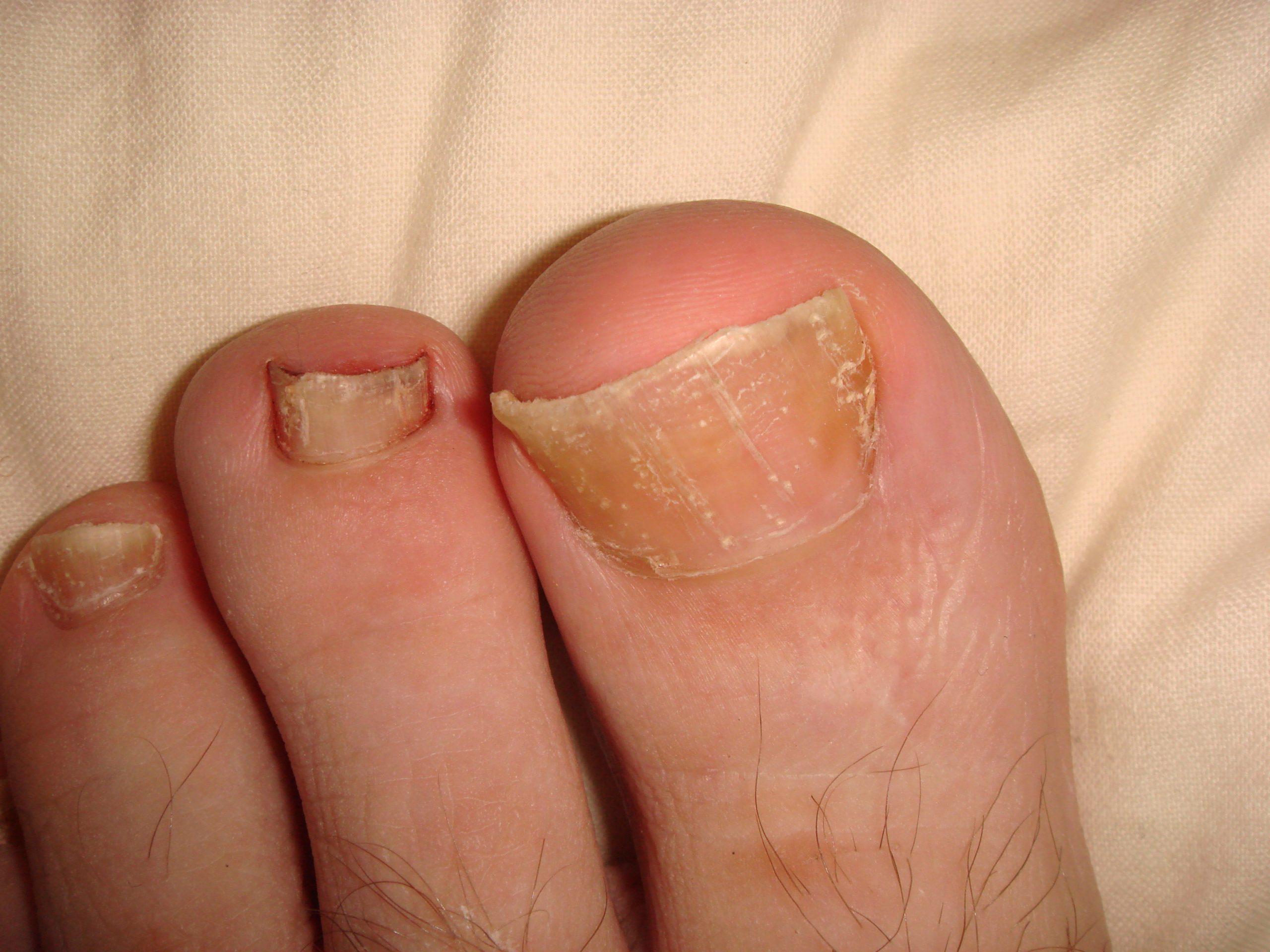Psoriasis of nails- psoriatic nail dystrophy