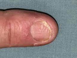 Psoriasis of nails- psoriatic nail dystrophy