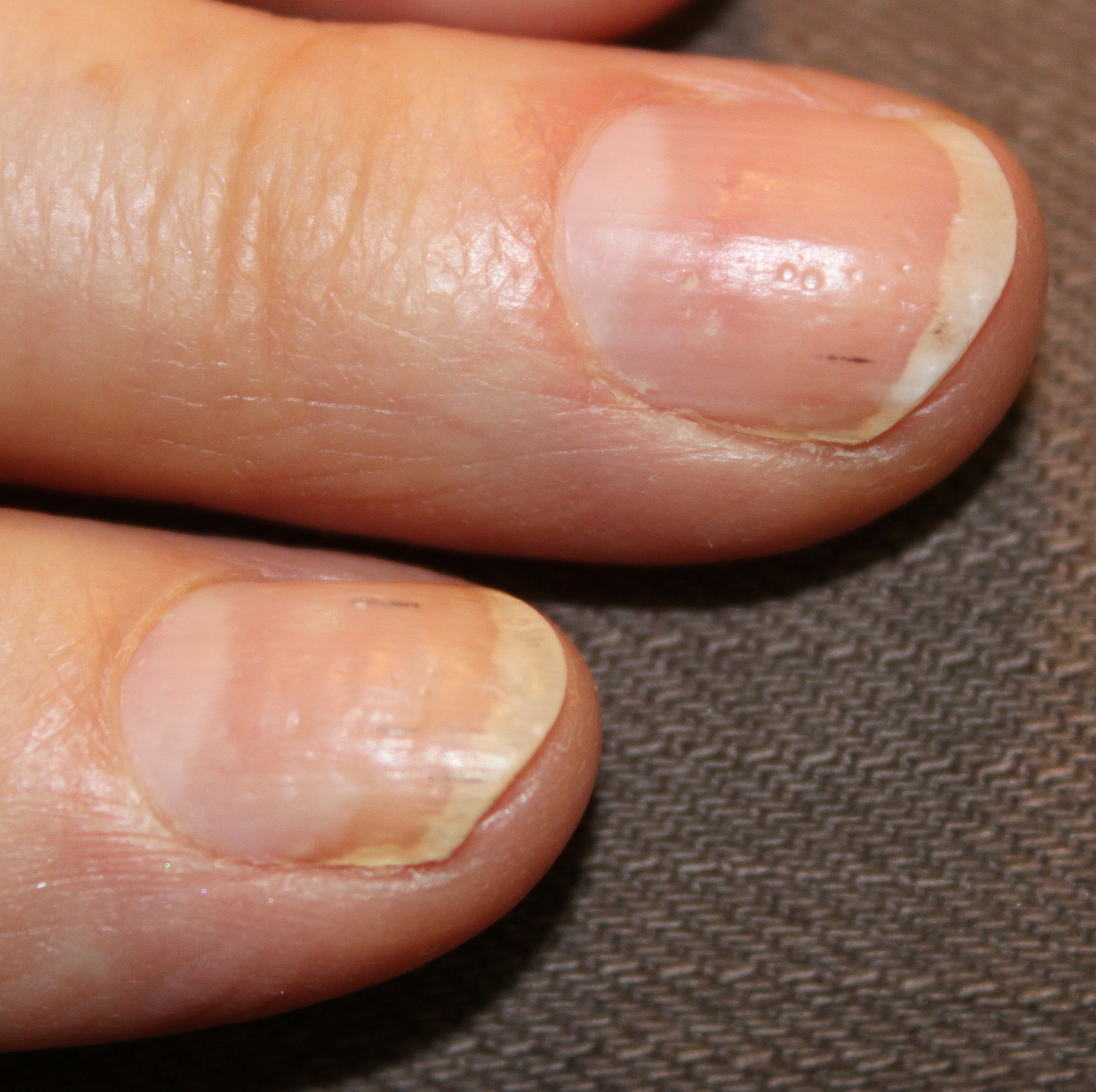 Nagų psoriazė - zvyneline ant nagu - nail psoriasis