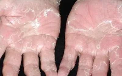 Peeling skin syndrome