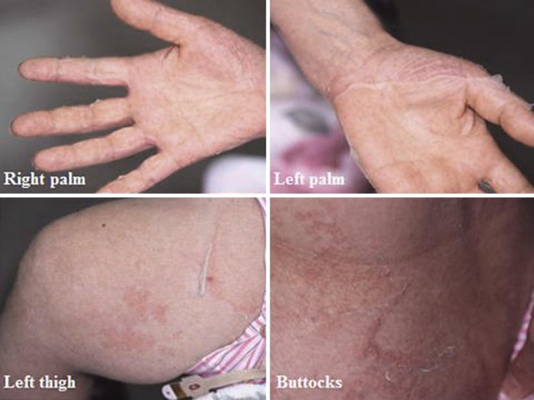 Peeling skin syndrome 3