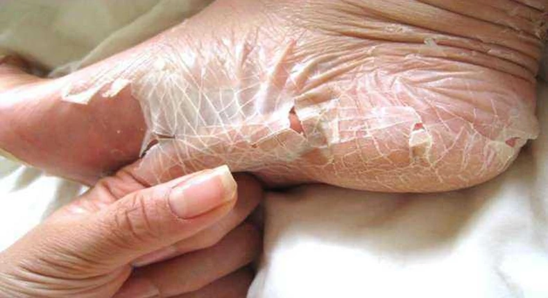 Peeling skin syndrome