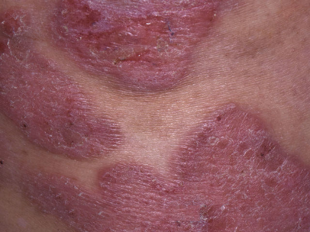 Mycosis Fungoides Plaque phase