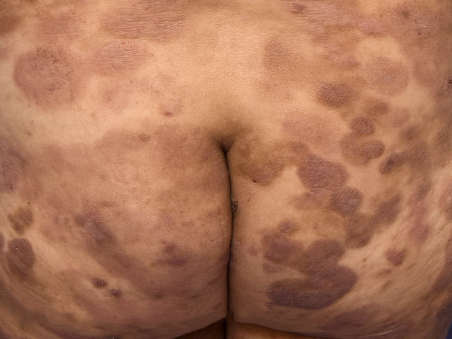 Mycosis Fungoides Plaque phase