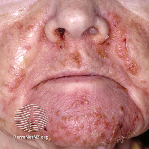 Necrolytic Migratory Erythema