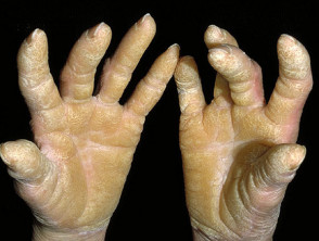 Palmoplantar keratoderma