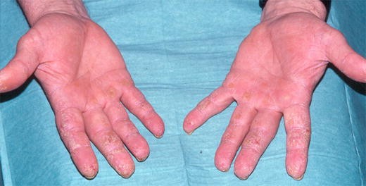 Paraneoplastic acrokeratosis (otherwise known as Bazex syndrome)
