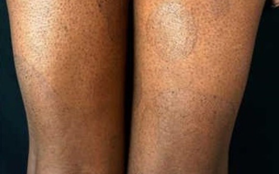 Paraneoplastinių virškinimo trakto navikų sindromų pasireiškimas odoje