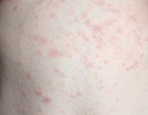 Pityriasis rosea - Dermatologist consultation online - iDerma